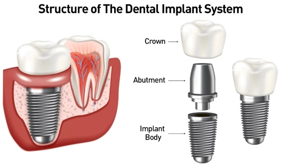 dental-implant-sistemi