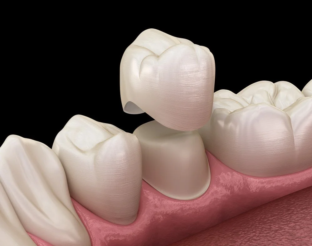 zirconia crown