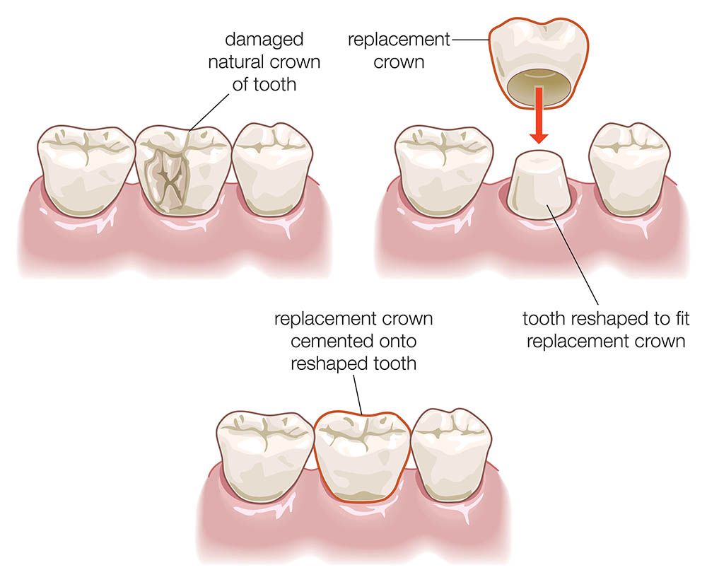 dental-crown-procedure-illustration-c33196.webp