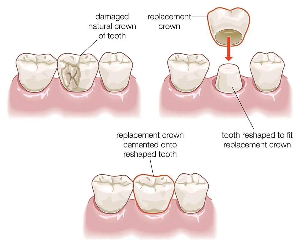dental-crown-procedure-illustration-c33196.webp