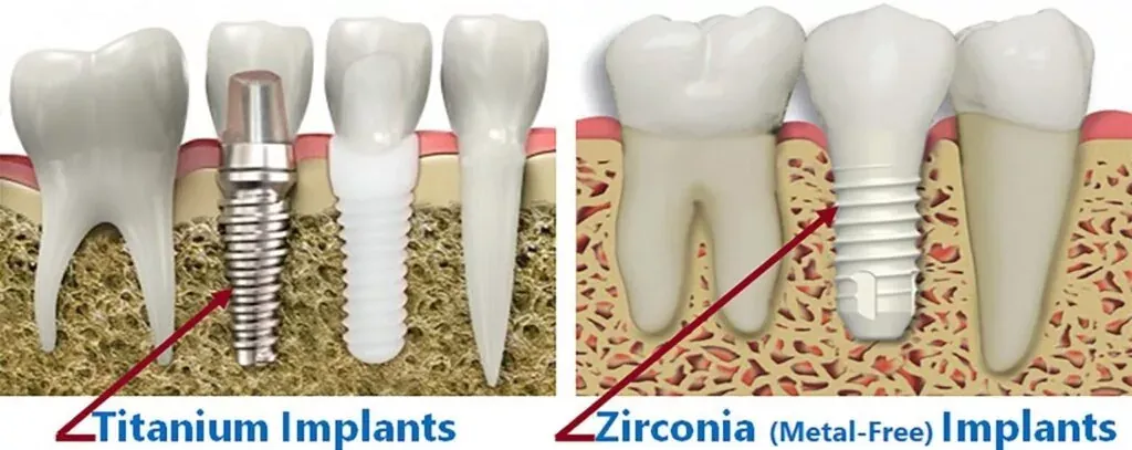 implant-en-zircone-en-turquie