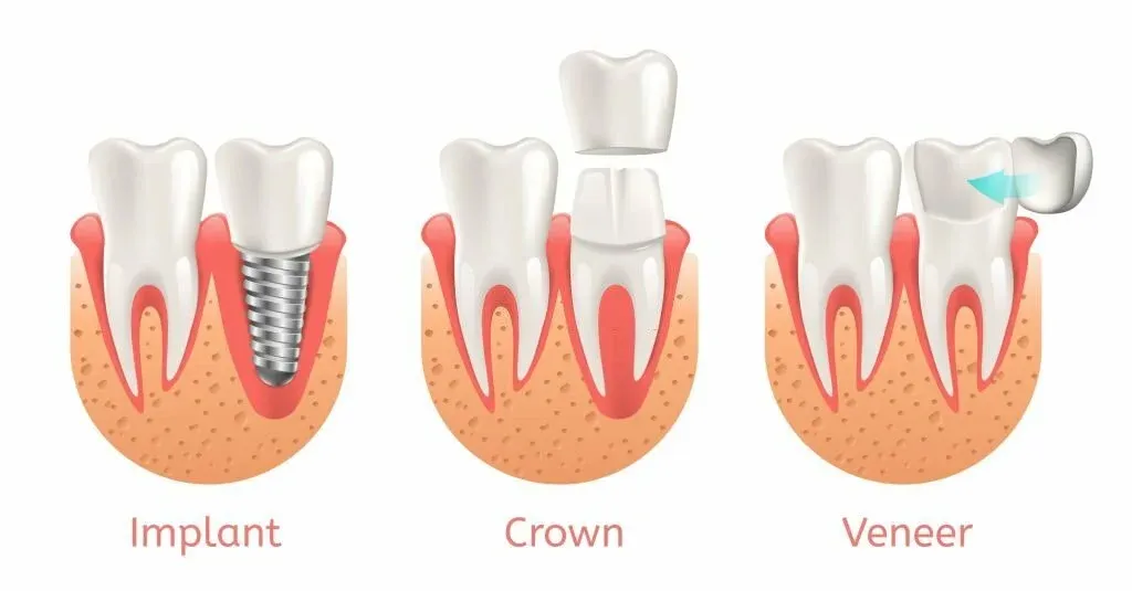 DEntal Veneers