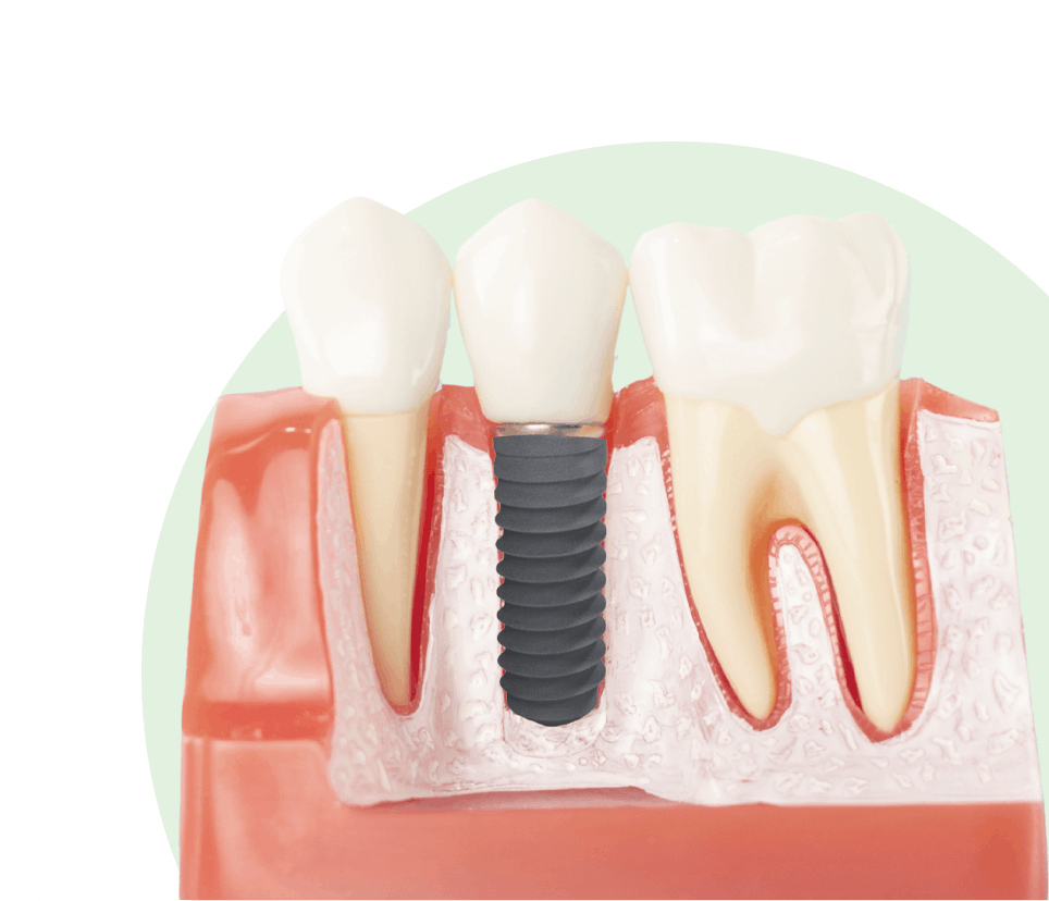 Implant Dentistry