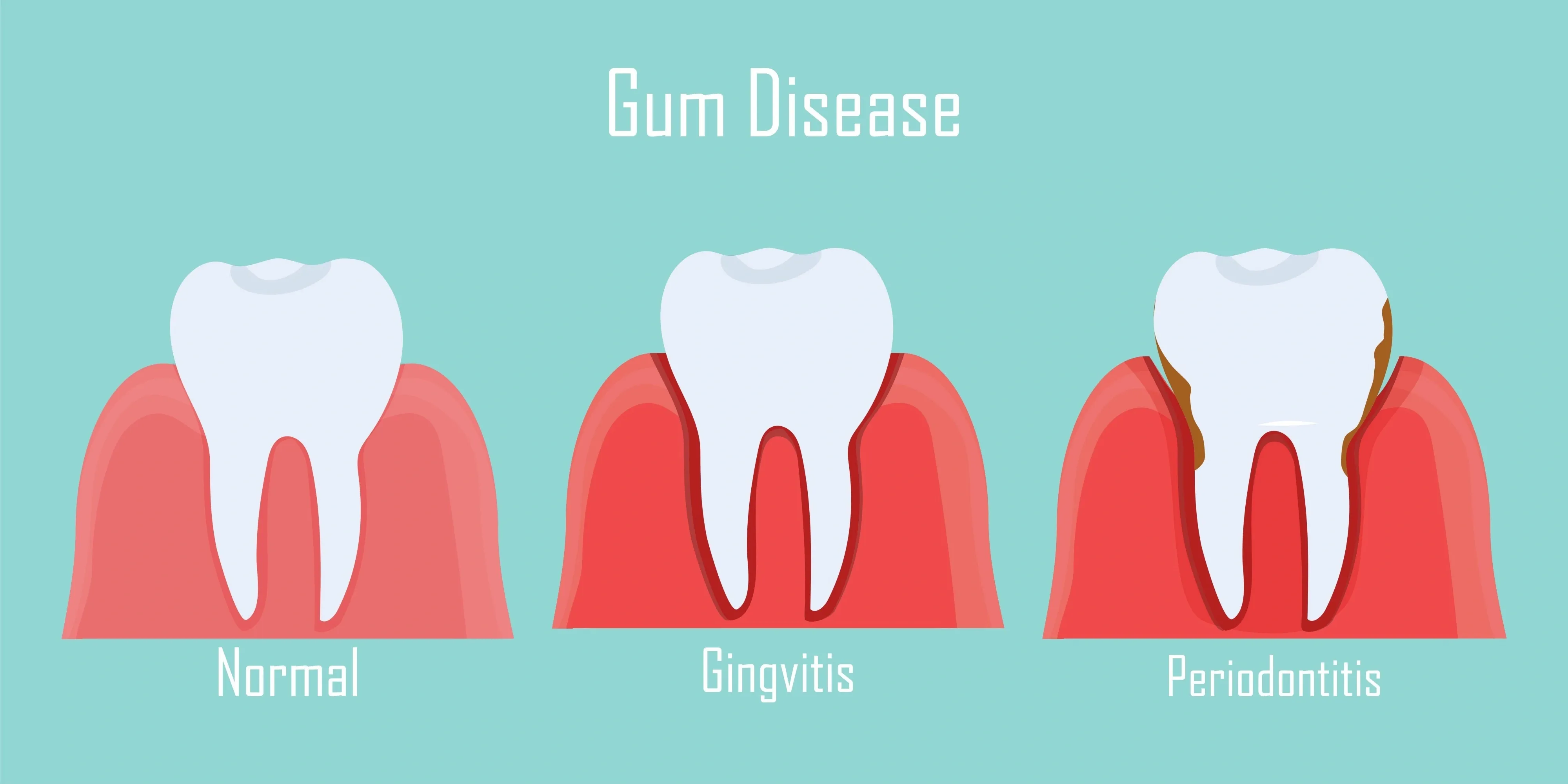 gum bleeding causes.webp