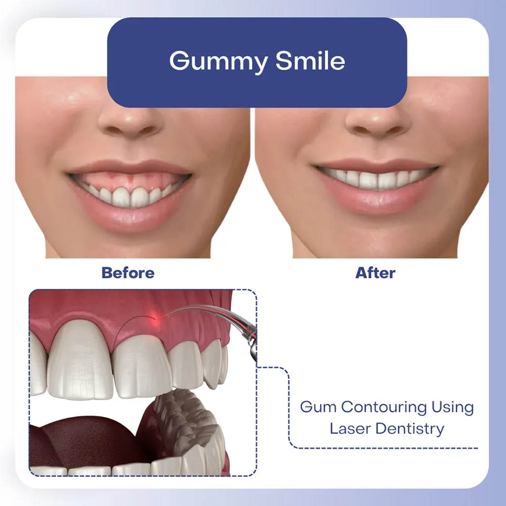 gum-contouring-using-laser-dentistry