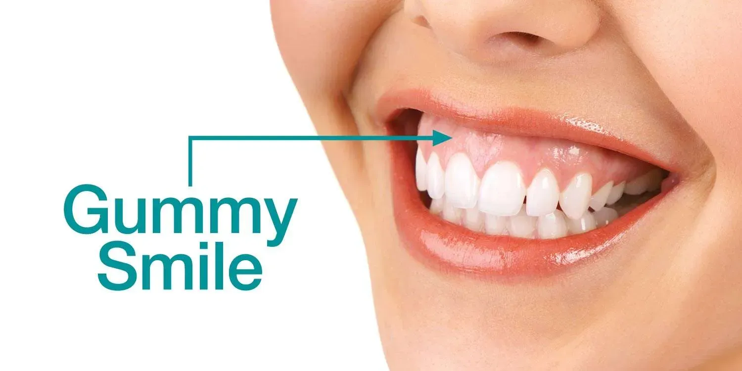 gummy-smile.webp
