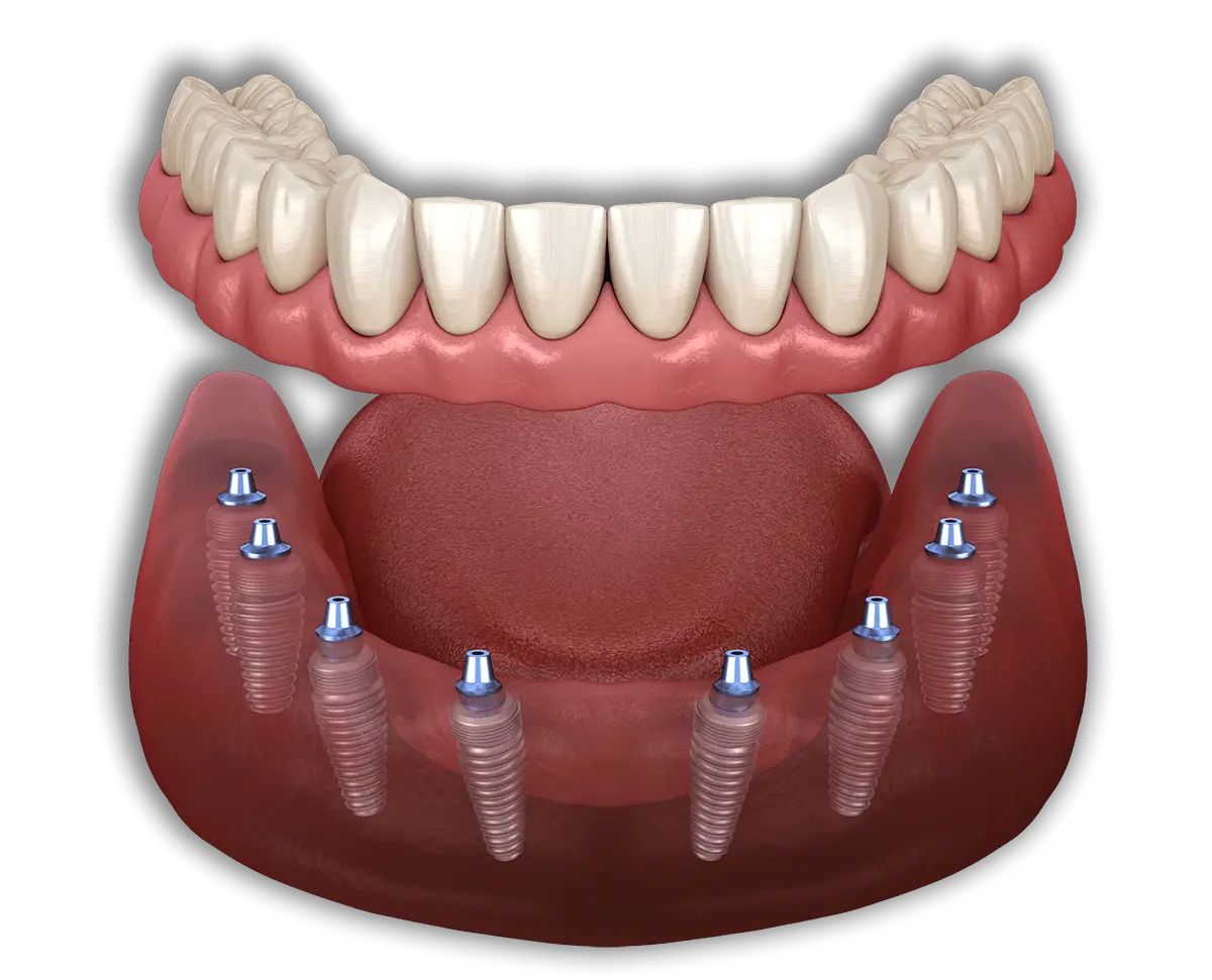 all-on-8-зубные-импланты-турция