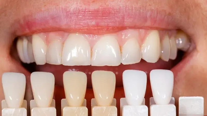 hollywood smile in der türkei