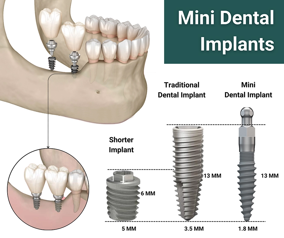 mini-dental-implantlar