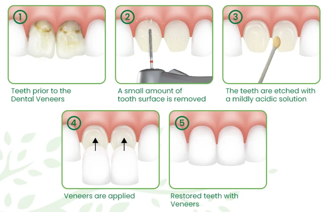 Porcelain Veneers