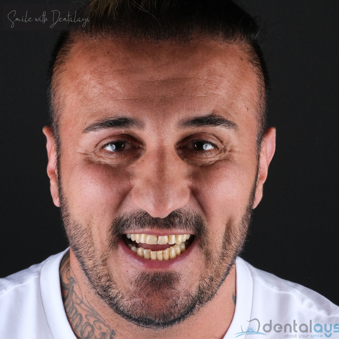 Before Treatment