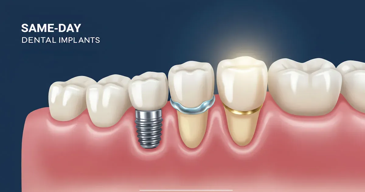 implants-dentaires-jour-meme-2.webp