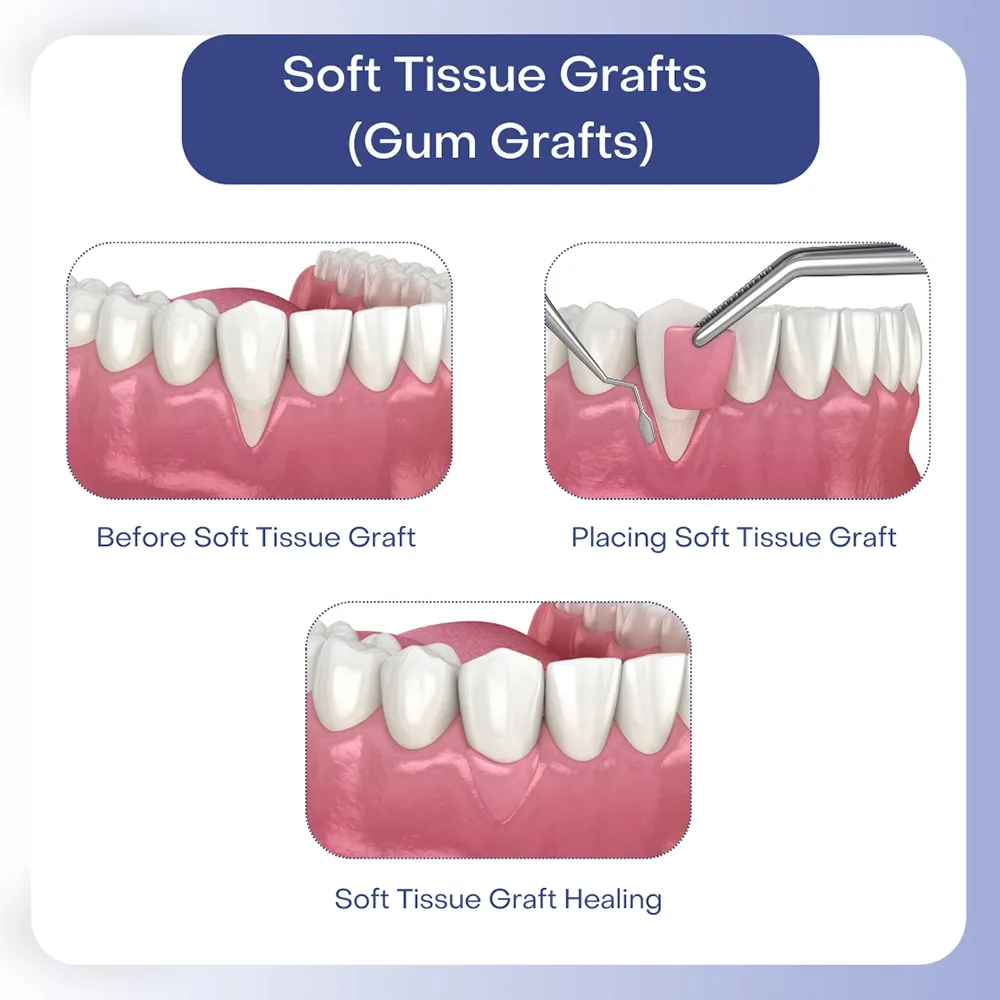 soft-tissue-grafts-turkey.webp