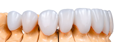 emax ceramic dental crown