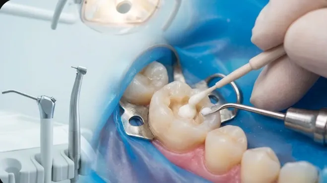What Is Pulp Capping? 
