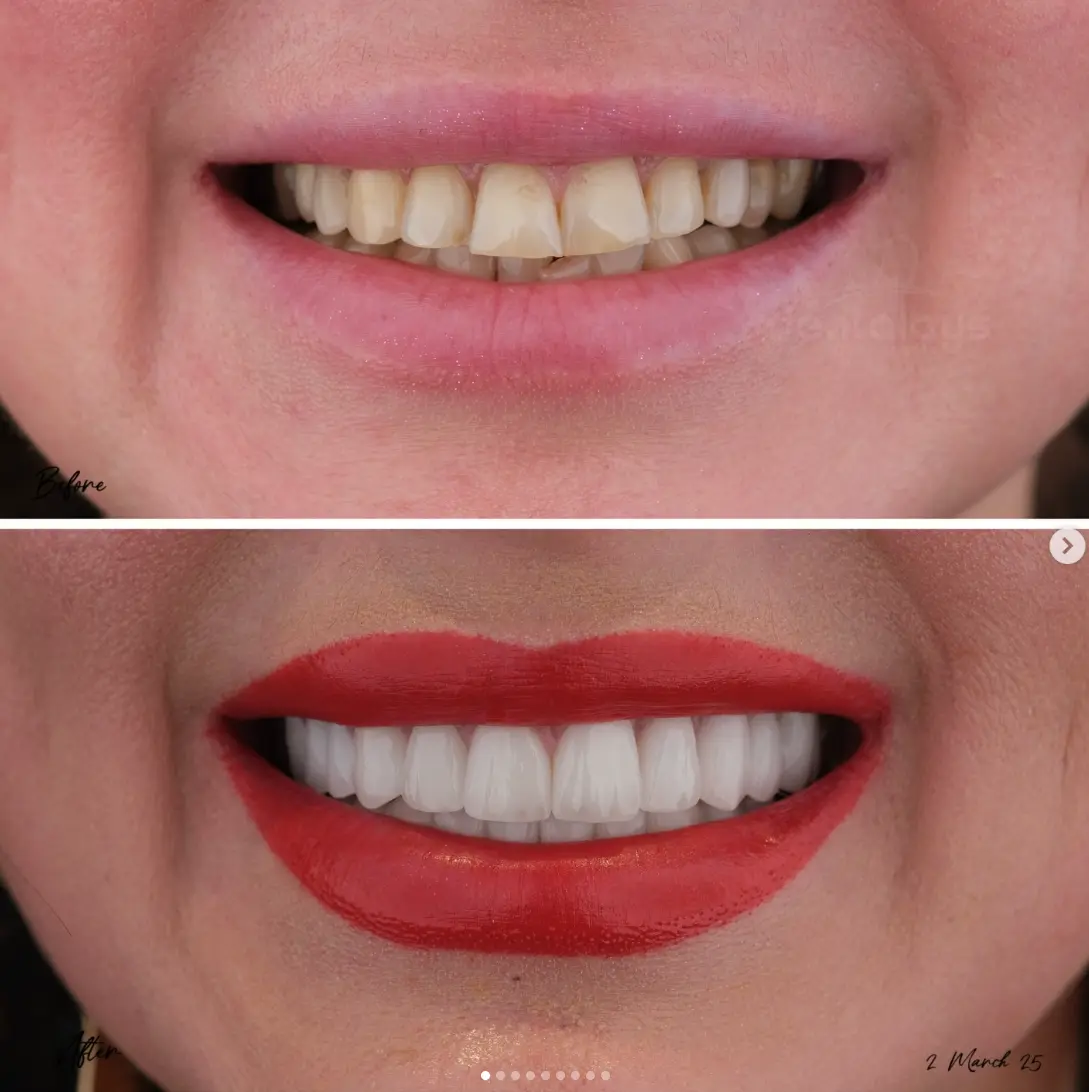 turkey teeth before after.webp