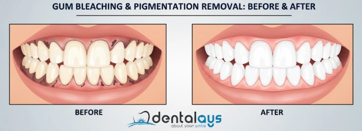 blanchiment gencives turquie