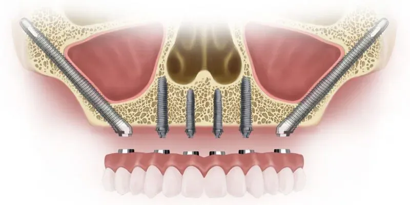 zigomatik-implantlar.webp